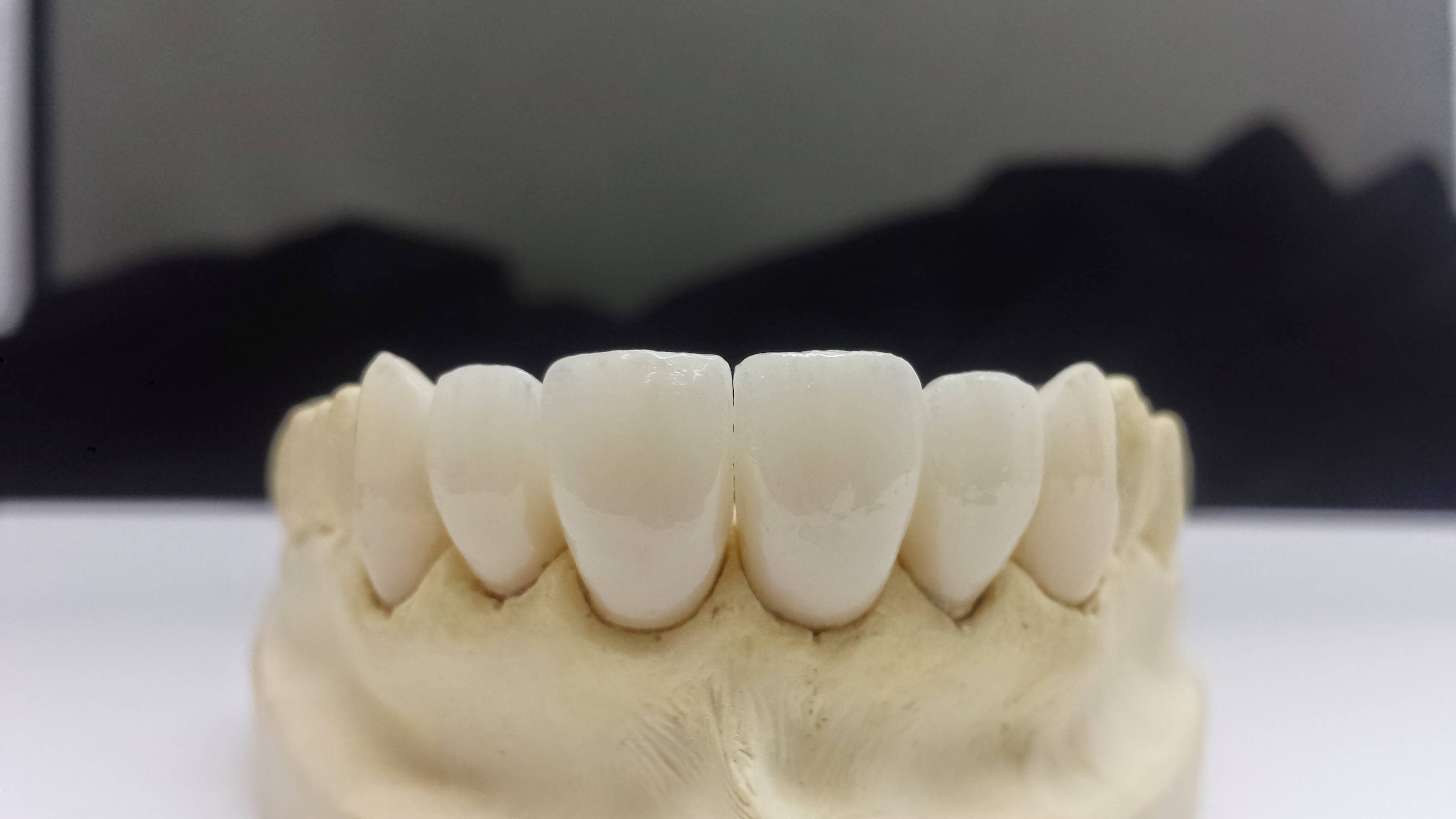 emax Anterior1