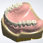 denture_design_1