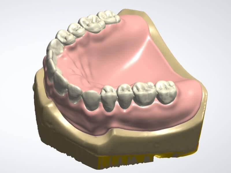 Digital Denture - CAD Design