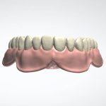 denture_design_2