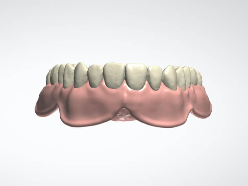 Digital Denture - CAD Design