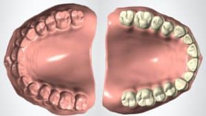 Denture Monoblock & Split File