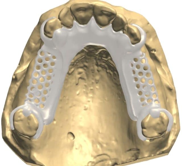 Flexible / Acetal Partial CAD Design CAE Dental