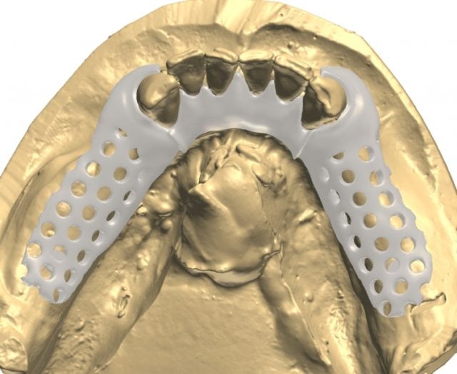 Flexible Partial / Acetal Partial Framework – CAD Design – CAE Dental