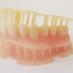 3dPrinted_Partial_Overdenture