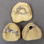 3 Metal Partial Frames