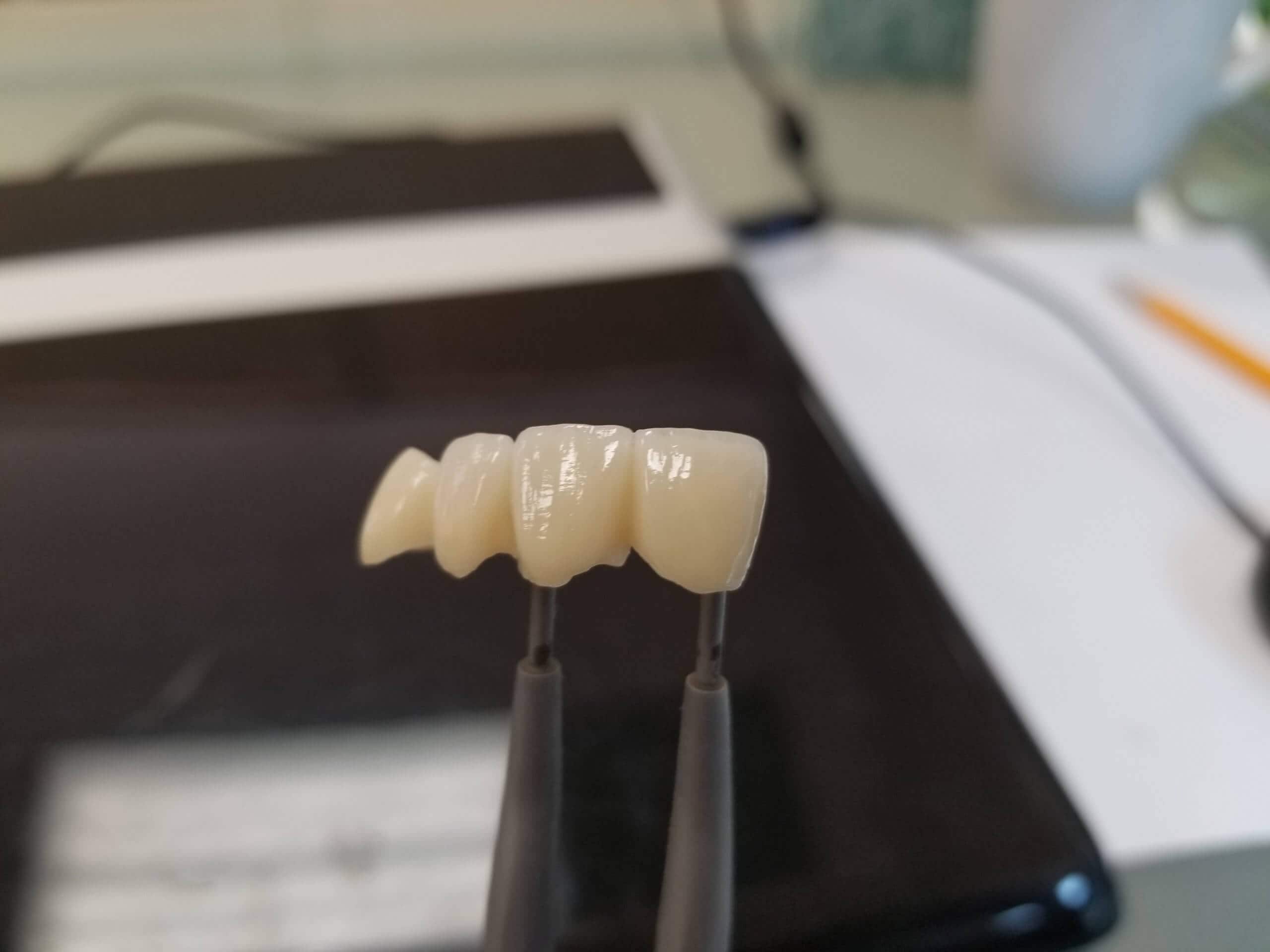 3D Printed Provisional / Temporary Restoration CAE Dental