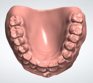 Denture Design Monoblock