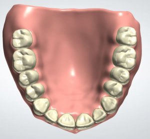 Denture Design SplitFile