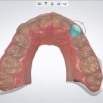clearaligner1