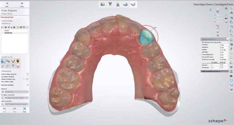 Clear Aligners – CAD Design – CAE Dental
