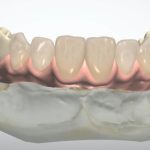 all-in-one-implant2