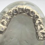 all-in-one-implant4