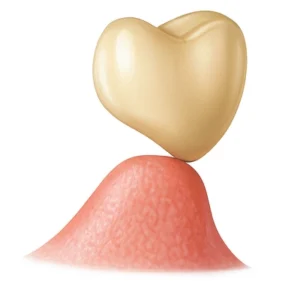 Modified Ridge Lap Pontic