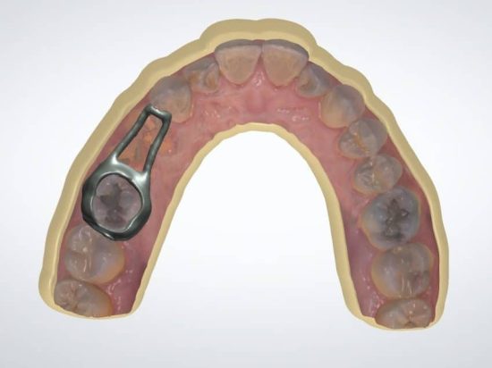 Space Maintainer – CAD Design – CAE Dental