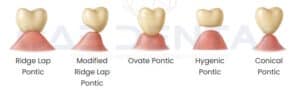 CAE Dental Pontics